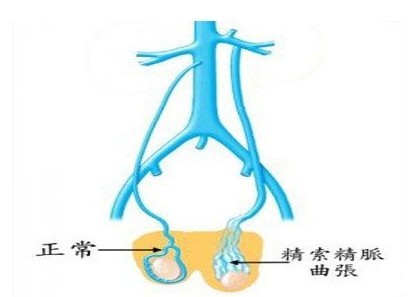 精索靜脈曲張會(huì)導(dǎo)致多大的傷害