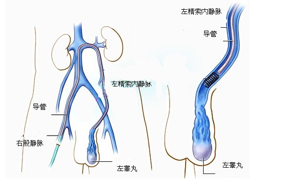 欽州精索靜脈曲張對(duì)男性有來什么危害